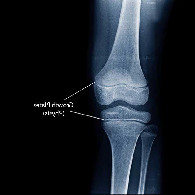 x光片显示膝关节连接胫骨和腓骨与图像上标记的生长板