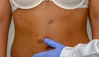 Person with a cafe-au-lait birthmark on stomach