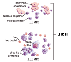 HSIL细胞图示.